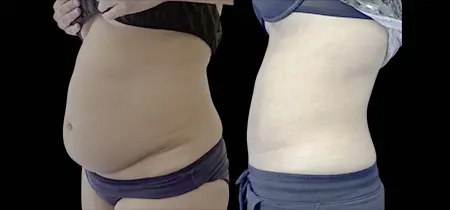 https www.realself.com question lipo-b12-injections-stomach-week Lipodissolve Fat Reduction In MI, NC, & SC - Fat-Dissolving Injections Liposuction Thigh: 7 Powerful Benefits