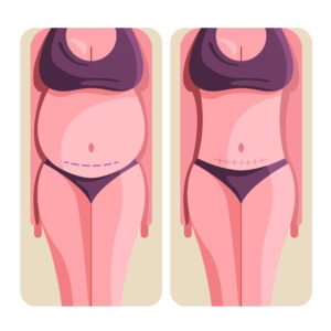 Tummy Tuck