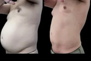 VASER Liposuction Before and After