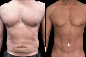 VASER Liposuction Before and After