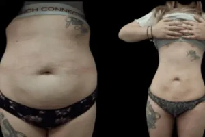 VASER Liposuction Before and After