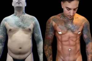 VASER Liposuction Before and After