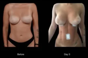 VASER Liposuction Before and After