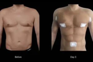 VASER Liposuction Before and After