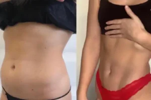 VASER Liposuction Before and After