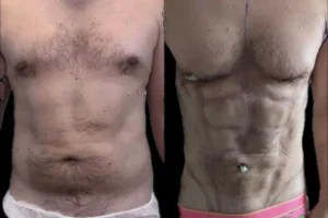 VASER Liposuction Before and After